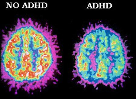 What struggles do people with ADHD face?